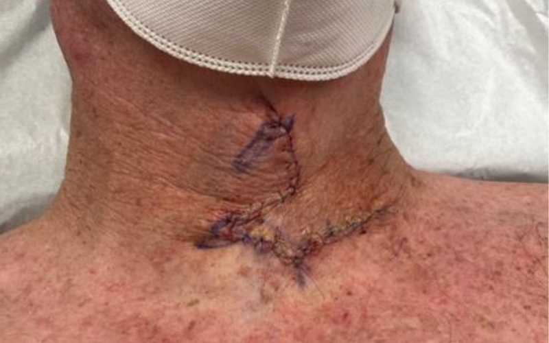 man with neck wound after mohs surgery