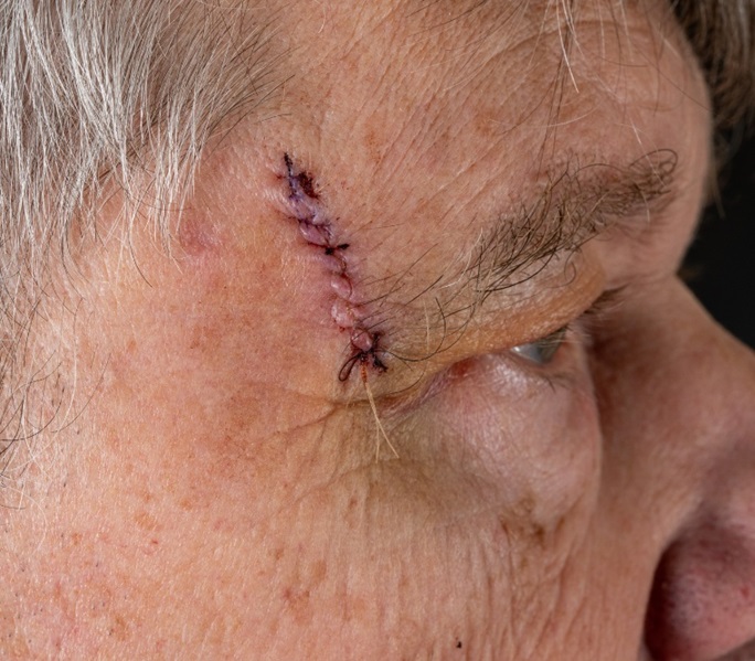 man with scar on his face after mohs surgery