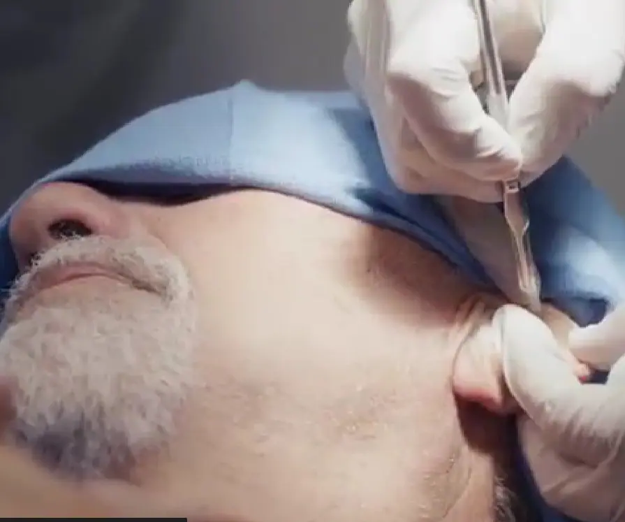 Mohs surgery on ear